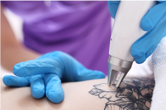 Tattoo-Removal