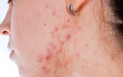 Treatment for Acne