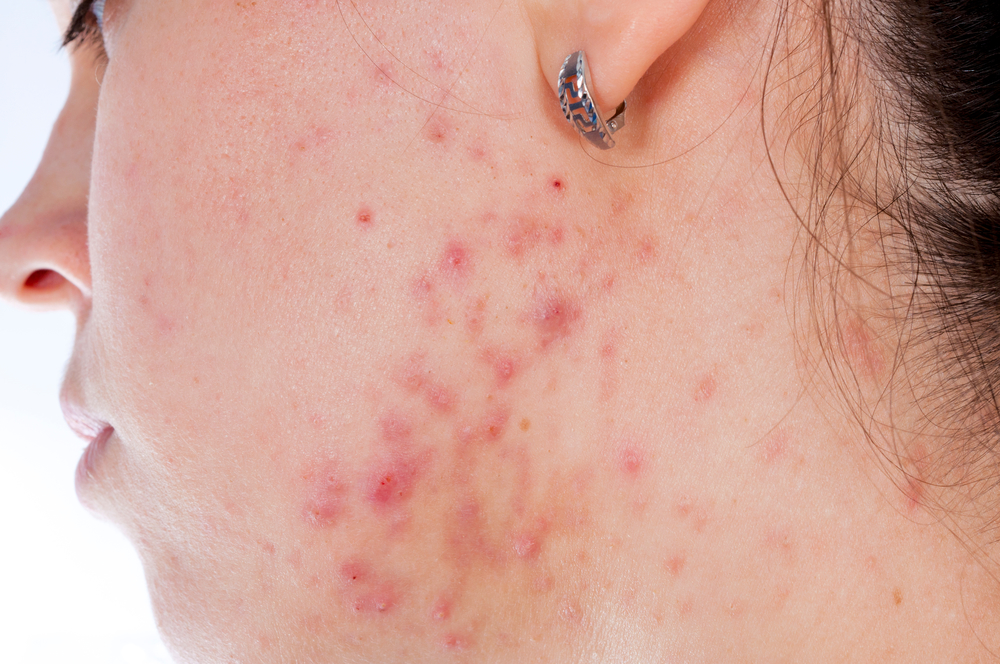 acne on woman's face
