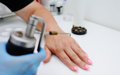 Treatment for Warts