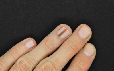 Check Your Nails for Melanoma