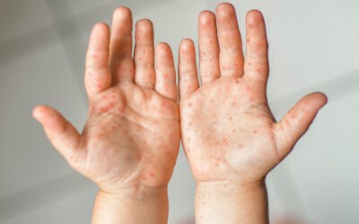 Tips For Preventing Hand-Foot-And-Mouth Disease