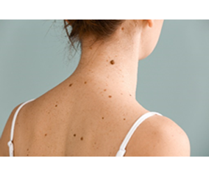 Moles vs. Freckles: What's the Difference?