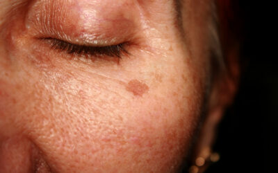 What Are Age Spots