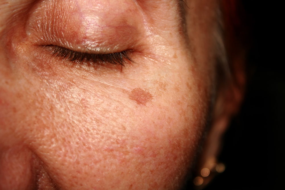 What Are Age Spots