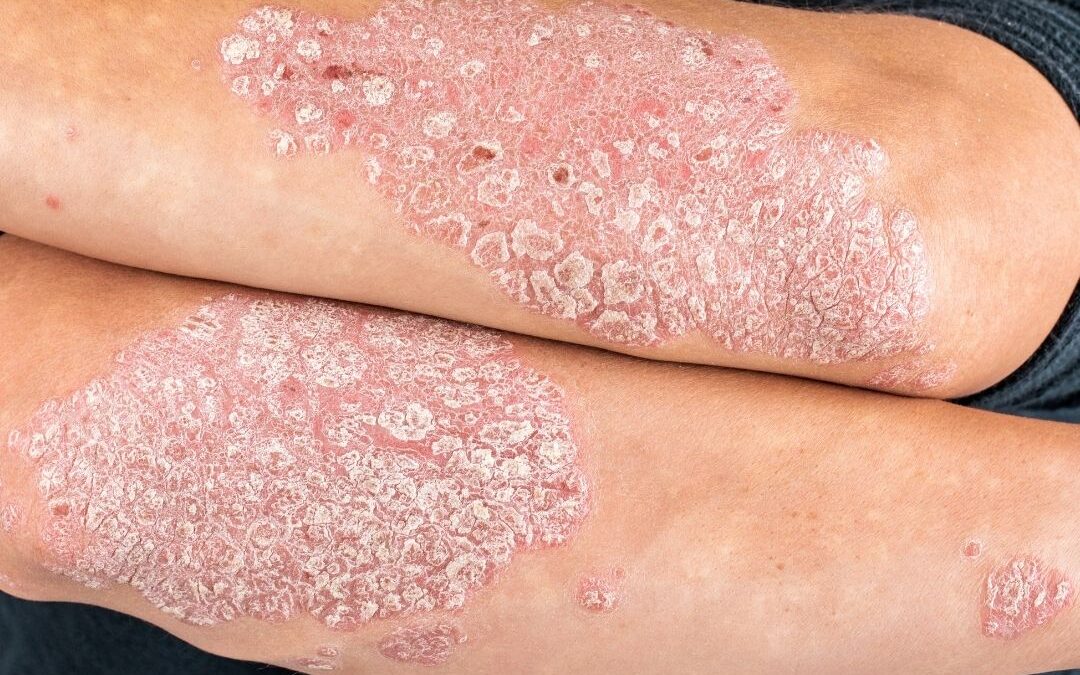 What is Psoriasis & What are the Symptoms and Treatment