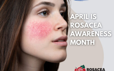 Understanding Rosacea: Shedding Light During Rosacea Awareness Month