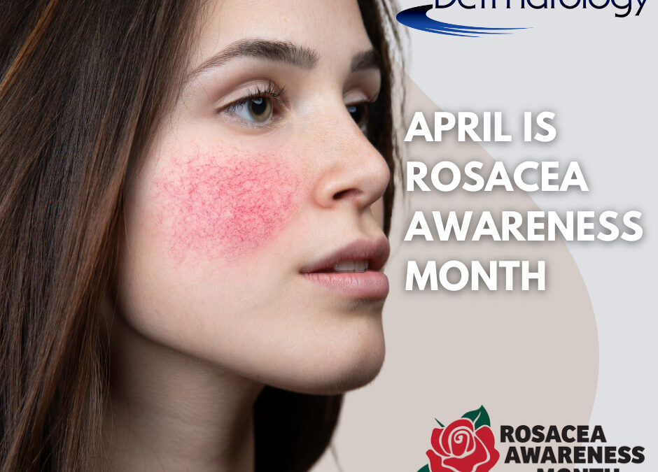 Understanding Rosacea: Shedding Light During Rosacea Awareness Month