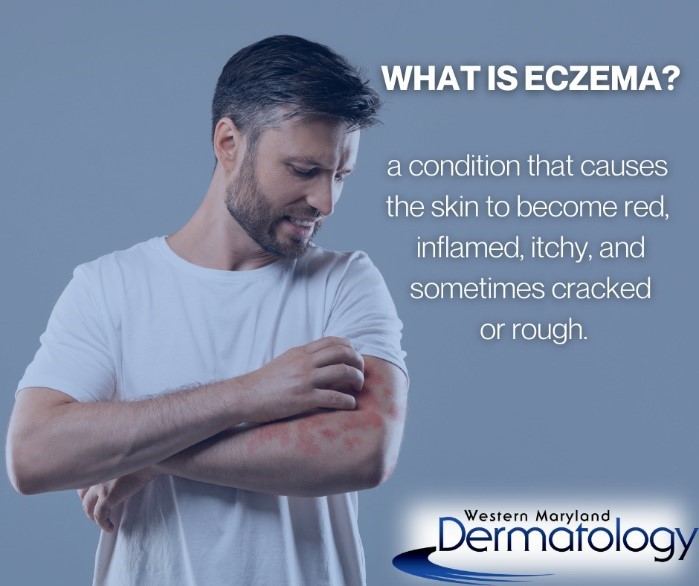 What is Eczema? A condition that causes the skin to become red, inflamed, itchy, and sometimes cracked or rough. - https://wmderma.com/