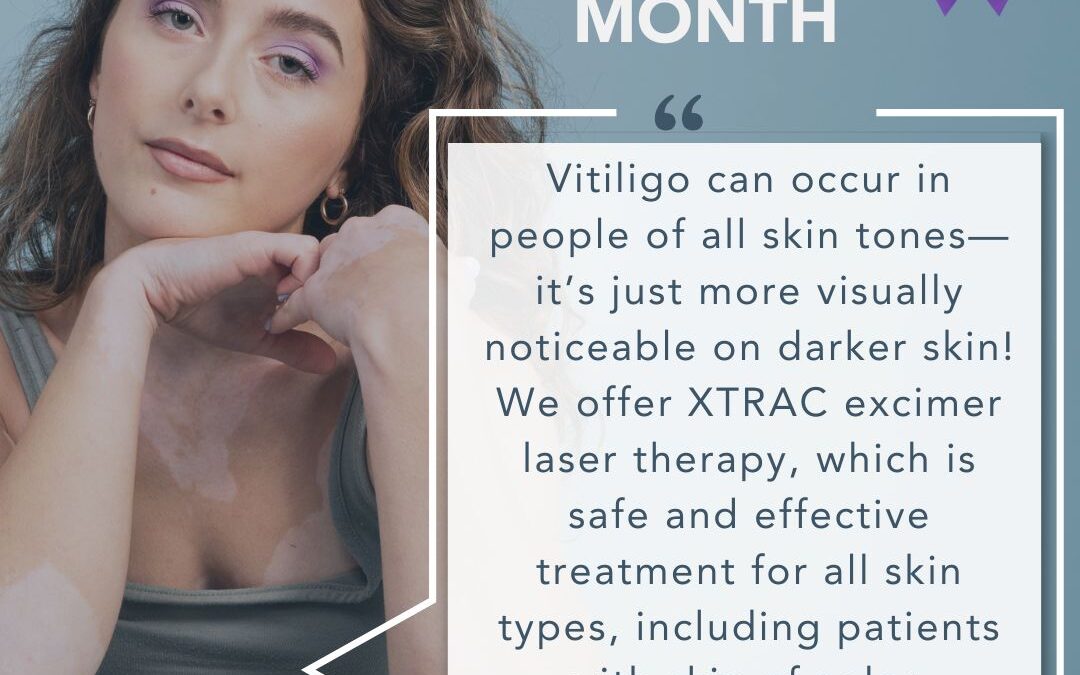 women with Vitiligo