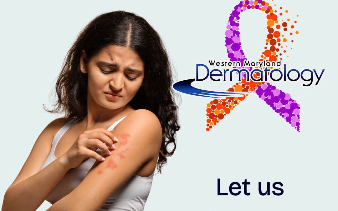 August is Psoriasis Awareness Month: What You Need to Know