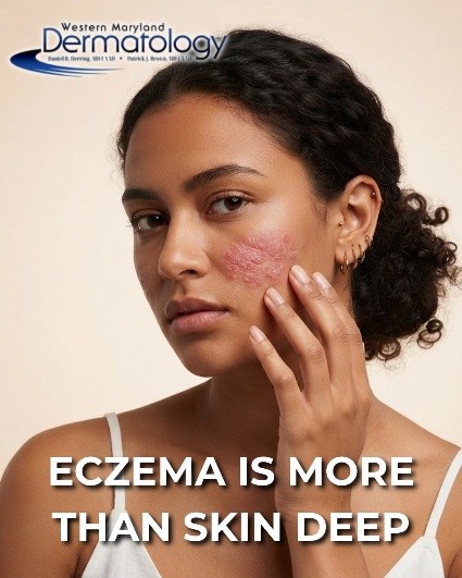 Eczema Awareness: Understanding Your Skin and Finding Relief